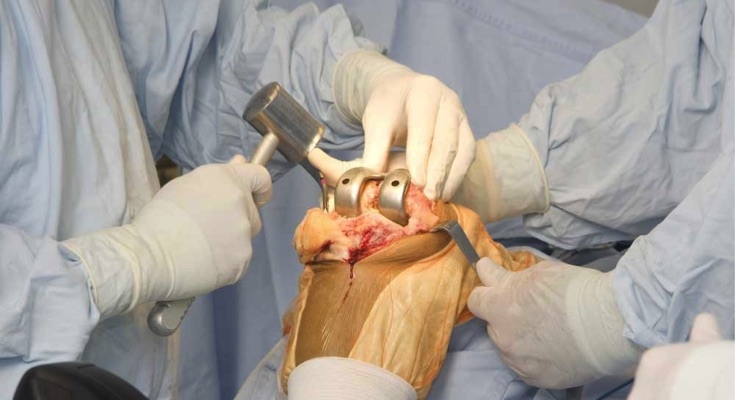 Knee Replacement Surgery