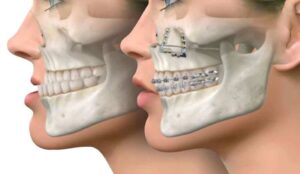 Jaw-Surgery