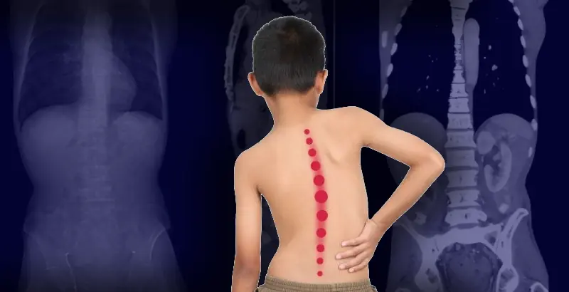 scoliosis-treatment