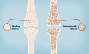Osteoporosis-treatment