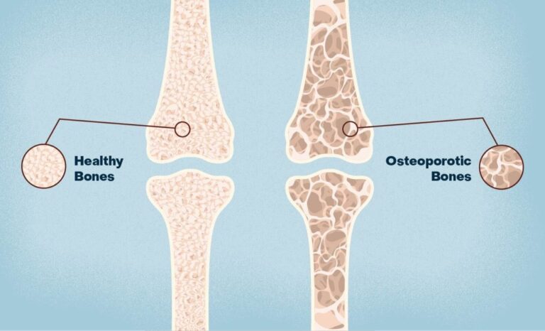 Osteoporosis-treatment