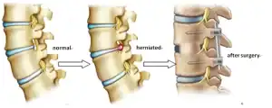 Herniated Disc Recovery