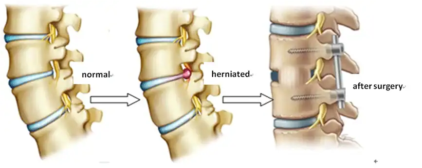 Herniated Disc Recovery