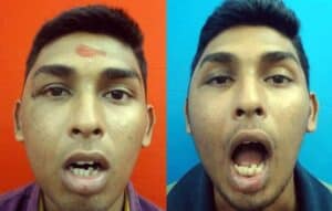 Facial fracture treatment