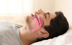 Sleep apnea treatment