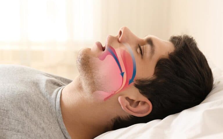 Sleep apnea treatment