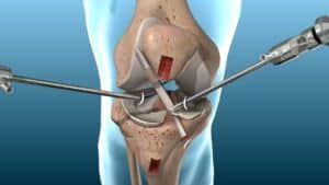 ligament reconstruction surgery
