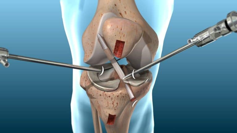 ligament reconstruction surgery