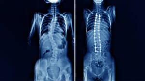 spinal fusion surgery