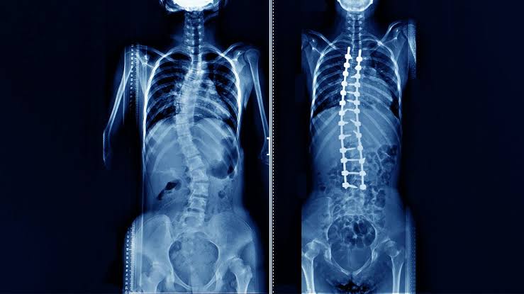 spinal fusion surgery