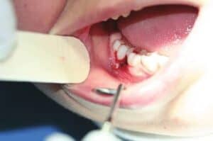 oral lesion removal