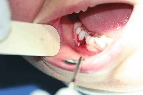 oral lesion removal