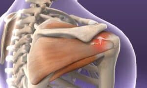 rotator cuff surgery