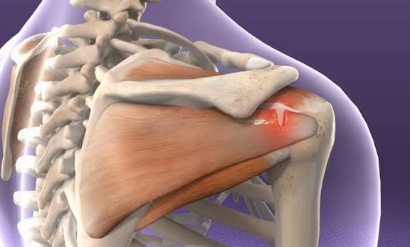 rotator cuff surgery